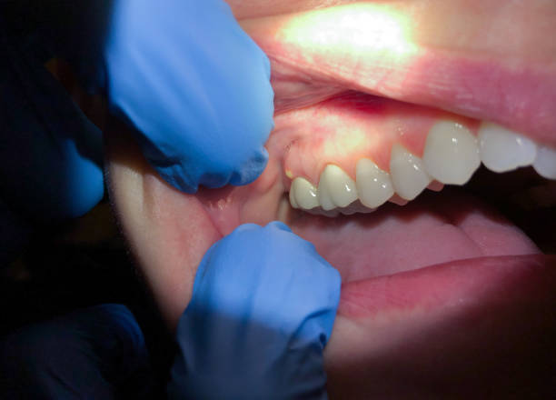 Best Emergency Wisdom Teeth Removal in Lansing, IL