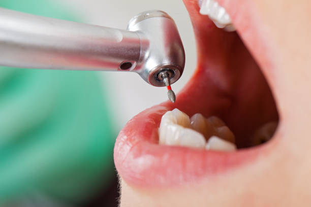 Best Emergency Root Canal Treatment in Lansing, IL